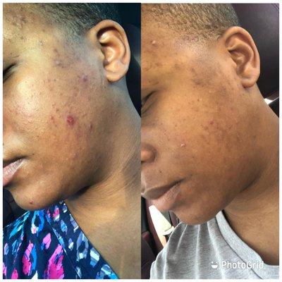 1 week acne program progress