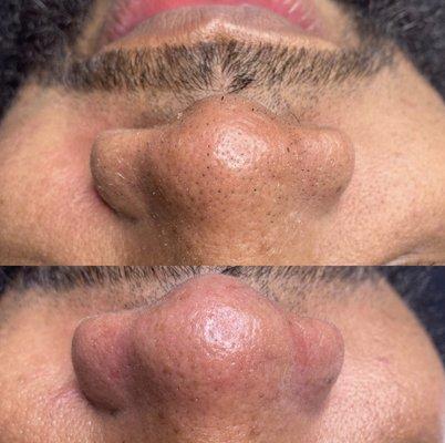 Deep pore facial