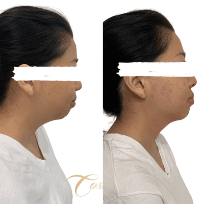 Double Chin and/or Weak Chin Laser Lipo and Contouring 1st Session Treatment