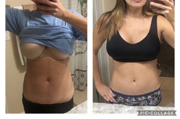 Breasts two weeks after surgery and stomach before and after