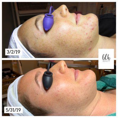 Before and after shot- inflamed and non inflamed acne