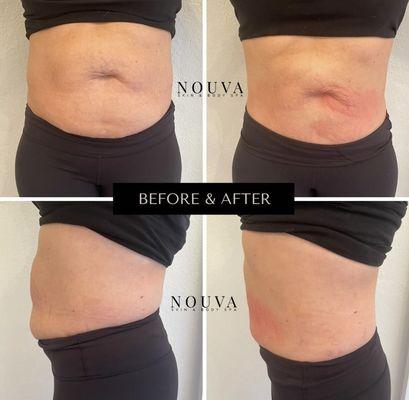 Cryoskin slimming (1 treatment)