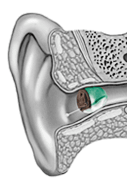 Invisible In the Canal (IIC) Hearing Aids