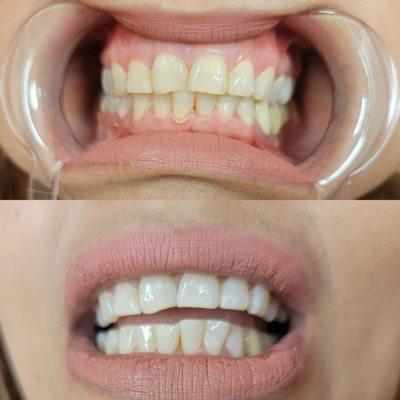 Don't miss out this months special
Teeth Whitening
$1 per minute
30 minutes $30
60 minutes $60
#Mantecaca
This are results in just 30 minute