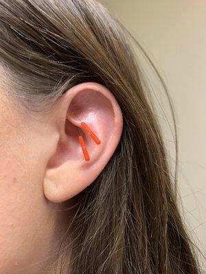 Auricular Acupuncture Treatment