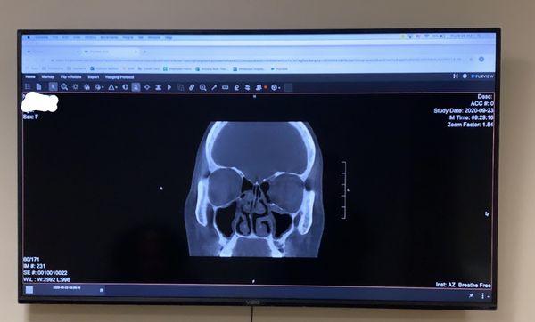 Cloud based technology allowing patients to review CT scans and see what the doctor sees inside of their nose, right in the clinic room!