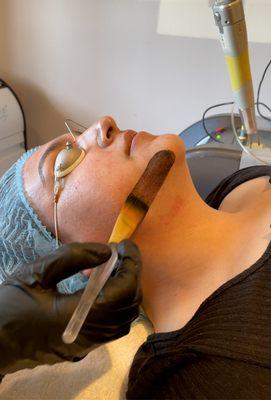 Carbon mask.. Prepping skin for a carbon laser facial