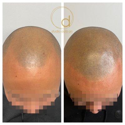 SMP(scalp tattooing) Hair Density work