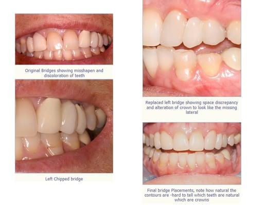 Patient had two bridges that were constructed to replace her missing lateral incisors, original bridges showed to be too larg...