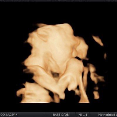 The quality of the 3D Ultrasound pictures I got from "Motherhood Ultrasound"