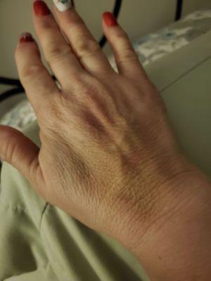 Taken 3 days later where they administered contrast for part 2 of MRI, bruise takes up 85% of my hand and wrist.