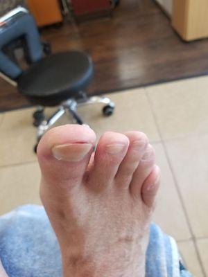 The cut on the tip of my toe