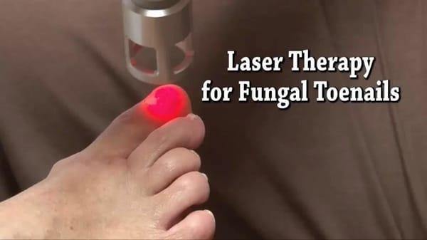 Treating Toenail Fungus with Laser Therapy at Adler Footcare