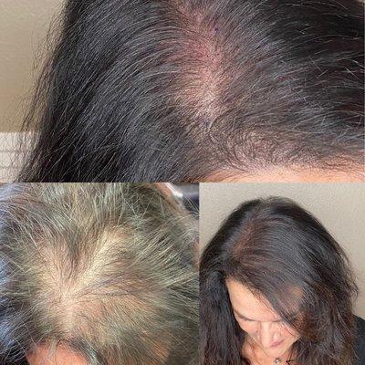 Scalp Micro Pigmentation before and after by Eileen