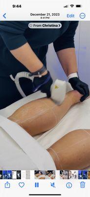 Laser Hair Removal