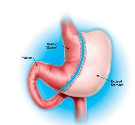 Laparoscopic Gastrectomy Sleeve