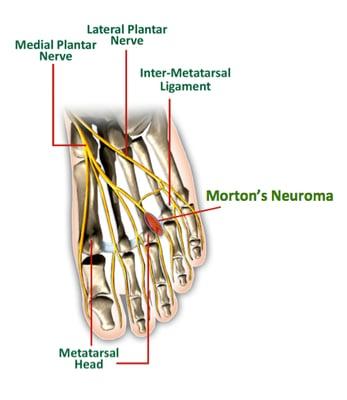 What is Morton's neuroma?