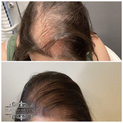 Scalp Micropigmentation (SMP)