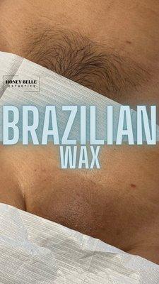 Brazilian wax before and after