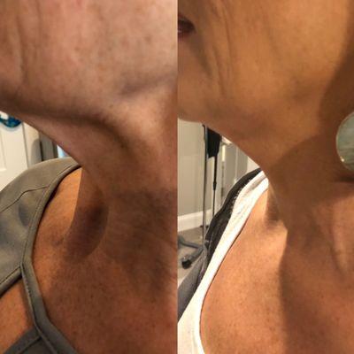 Noninvasive neck lift with botox