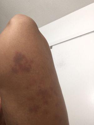 Bruises behind my arm