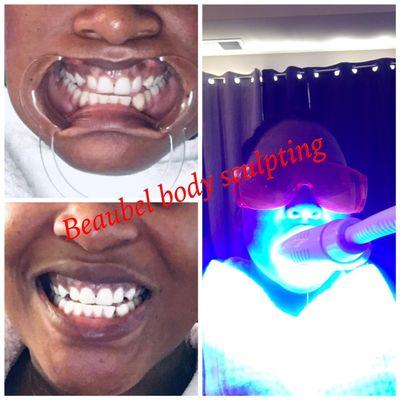 Teeth whitening