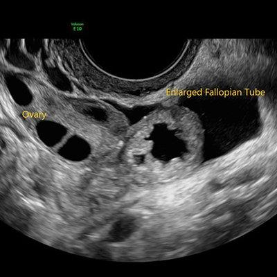 Ovary and enlarged fallopian tube