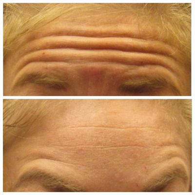 Forehead before and after.