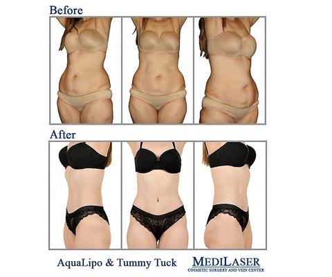 Aqualipo-Lipo-Liposculpture-TUMMY TUCK-Cosmetic-Surgeon-Dr-Giraldo