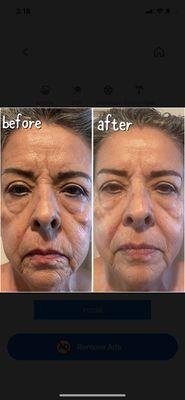 Facelifting Buccal Facial