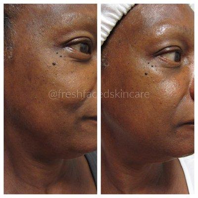 Before & After from Signature Customized Peel Treatment (series of 6)