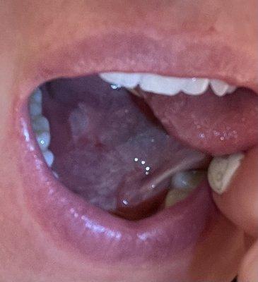 Iatrogenic trauma, 6mm sublingual ulcer from improper use of suction catheter by dental hygienist, 2 days post procedure.