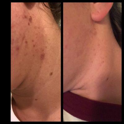 Before and after photo of skin scarring and hyperpigmentation after one IPL and chemical peel treatment.