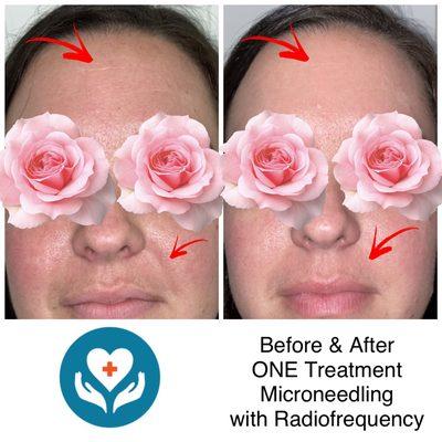 Microneedling with Radiofrequency. Skin tightening, decreased redness & pores.