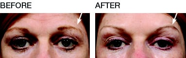 BrowRise treatment for eyebrows.   Actual patient of Dr. Bracci. Unretouched photo.