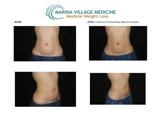 Coolsculpting before and after 1 treatment