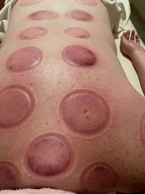 When your body builds up too many toxins.cupping is one of the most effective methods