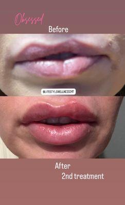 Lip filler with RHA