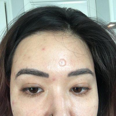 A very prominent scar on my forehead from the botched mole removal done at Agape.