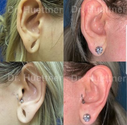 Earlobe repair New York City