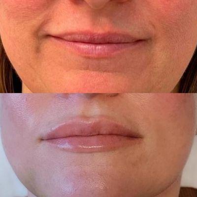 Lip filler with Restylanes KYSSE!