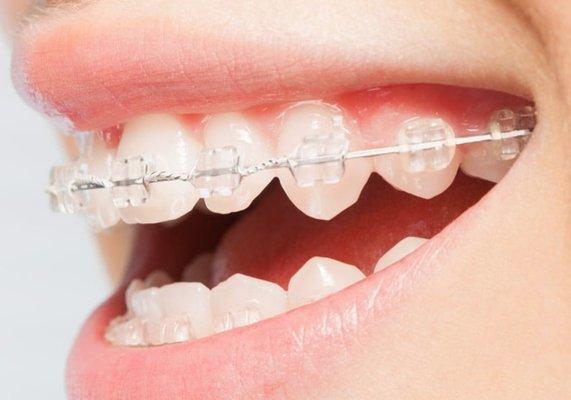 Discover a new kind of braces with Dr. Carr Orthodontics in Roy, Utah. Contact our office today!