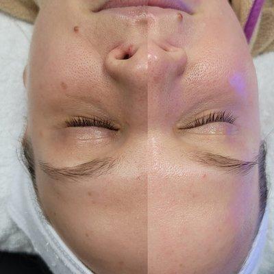 Before and after a Classic Hydrafacial.