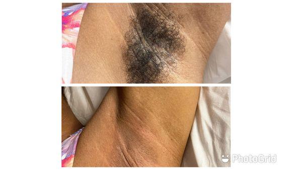 Before after waxing of Underarm.