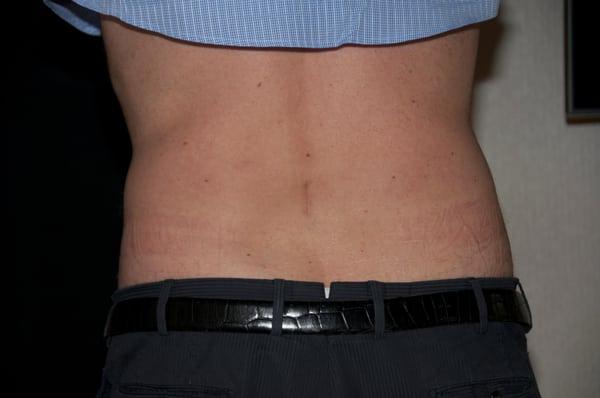 Wow! Love handles gone after one treatment! 