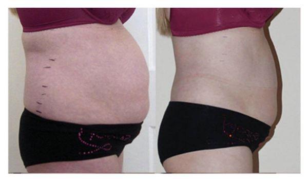 Non Invasive Liposuction