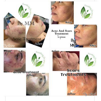 Treatments to remove acne, blemishes and scars 100% effective
Real photos and no filters