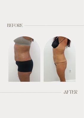 Body contouring results