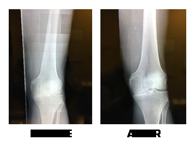 Before and After Stem Cell Therapy