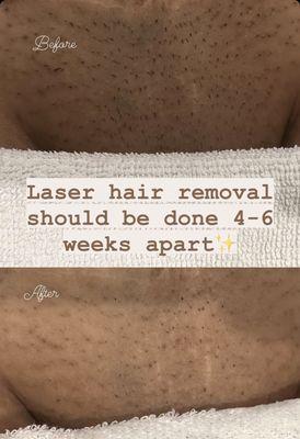 Reduced ingrown hairs: Laser hair removal can help reduce the occurrence of ingrown hairs, which are common with traditional hair removal